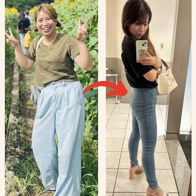 30代女性女性のBefore（左）とAfter（右）の比較写真。20代の時よりも綺麗になった事例。