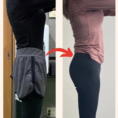 40代女性のBefore（左）とAfter（右）の比較写真。エステスタッフにも驚かれたほどの変化があった事例。
